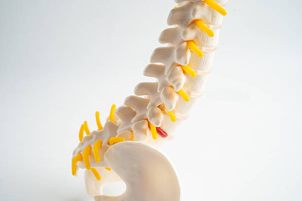 istock Lumbar spine displaced herniated disc fragment, spinal nerve and bone. Model for treatment medical in the orthopedic department. 2231235873