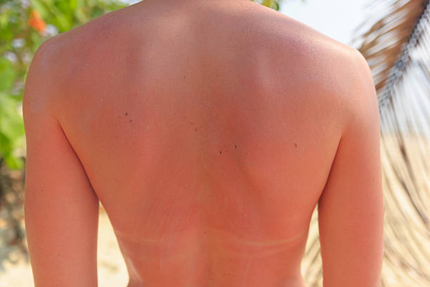 A person stands with sunburned skin on their back, showing visible redness. They are enjoying a sunny beach day surrounded by palm trees and sand during midday.