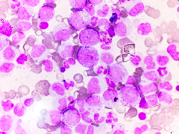 istock Chronic myeloproliferative neoplasm (MPNs). 2231398025