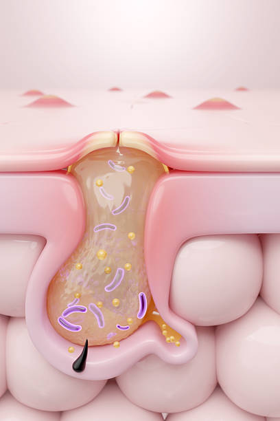 Severe acne breakout, cross-section of an inflamed pustule with a background of widespread pimples. conceptual, vertical 3D illustration.