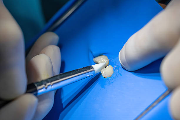 istock Tooth restoration after root canal with composite filling application under rubber dam 2231719797