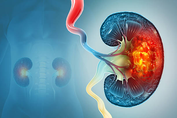 istock Diseased human kidney. kidney cancer. 3d illustration 2232155967