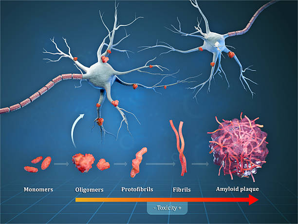 Diagram showing different steps leading to the formation of amyloid plaques in Alzheimer disease. Digital illustration, 3D render.