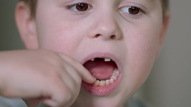 istock A Boy Aged 5-6 Years Experienced Loose Front Teeth. Children Dentistry Concept. Changing Teeth. 2232337849