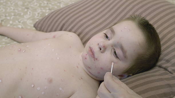 istock A Child Experiencing a Skin Condition chickenpox While at Home Understanding Symptoms and Care 2232337872