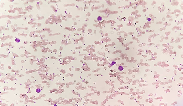 istock Abnormal structural  RBC, RBC diseases with high platelet count under microscopic examination of hematological stained slide. 2232684467