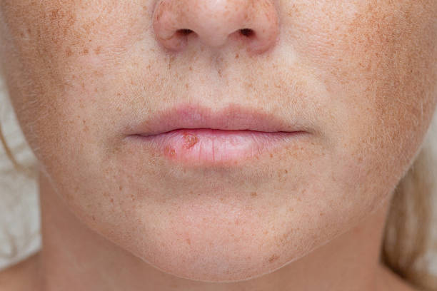 istock Cold sore on womans lip, herpes simplex infection 2232841594