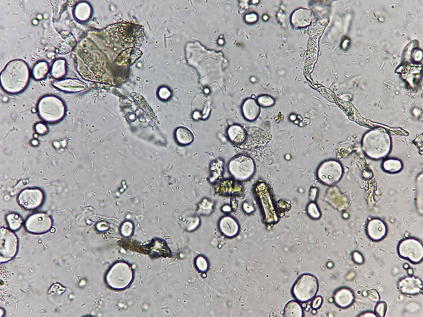 istock Microscopic urinalysis, uric acid, Calcium oxalate, triple phosphate. 2233099847