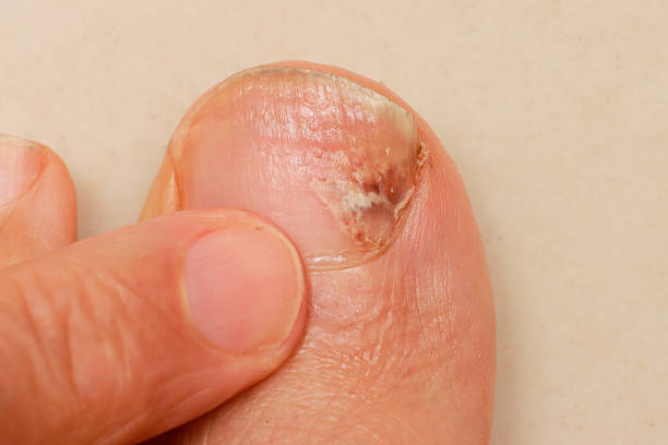 istock Man with a painful bruised and infected big toe 2233341957