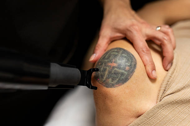 istock Dermatologist applies cutting-edge technology to patient's shoulder to remove a tattoo 2233795677