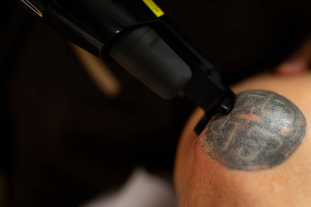 istock Dermatologist applies cutting-edge technology to patient's shoulder to remove a tattoo 2233795681