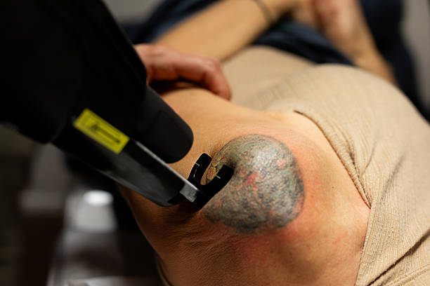 Female dermatologist applies laser and cutting-edge technology to a female patient's shoulder to remove tattoo ink. Buenos Aires, Argentina.