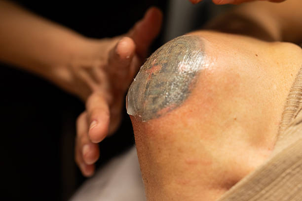 Dermatologist applies cutting-edge technology to patient's shoulder to remove a tattoo