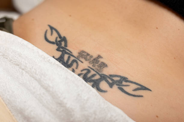 Female dermatologist applies laser and cutting-edge technology to a female patient's back to remove tattoo ink. Buenos Aires, Argentina.