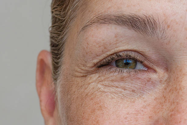 istock Natural eyes with excess eyelid skin, close-up 2233974530