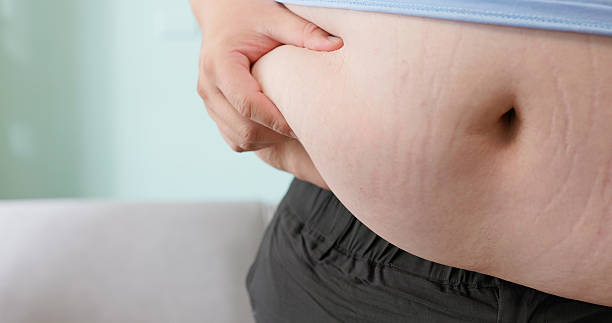 istock concept of stretch marks caused by obesity 2234129399