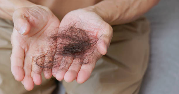 istock loss hair in hand 2234129535