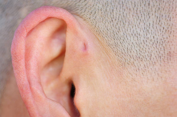 istock A preauricular sinus appears as a very small pit just in front of the external ear, these sinuses can drain a foul smelling discharge, and when this happens, they are prone to chronic infection. 2234225908