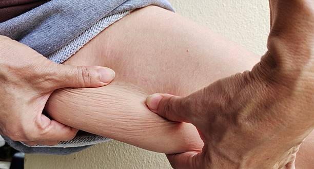 istock The Flabbiness and wrinkles on the leg. 2234239730