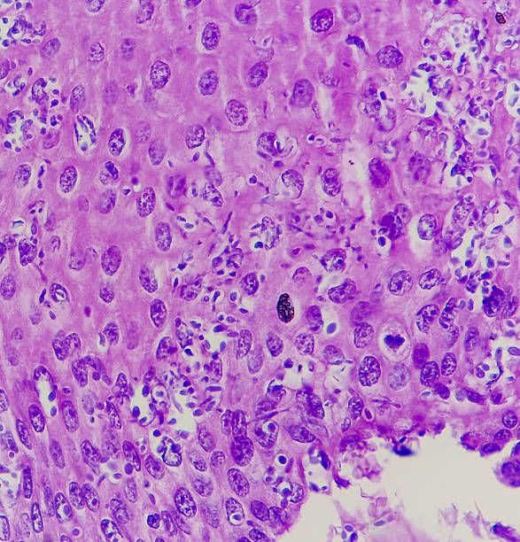 istock Endoscopic biopsy of oesophagus, microscopically show hyperplastic oesophageal mucosa, fibrinopurulent exudate and many spores of candida. Candidiasis. 2234243720