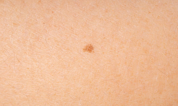 istock Skin mole spot closeup. Human birthmark, nevus macro texture 2234618645