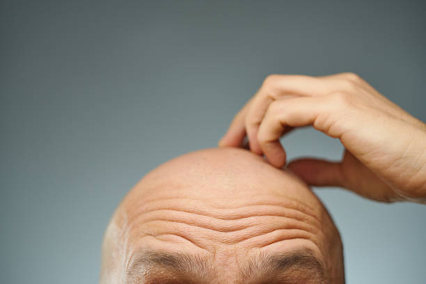 A man with arched brows and a furrowed forehead scratches his bald head, only the upper part of his scalp visible