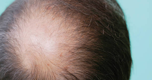 istock observe signs of baldness 2235135822