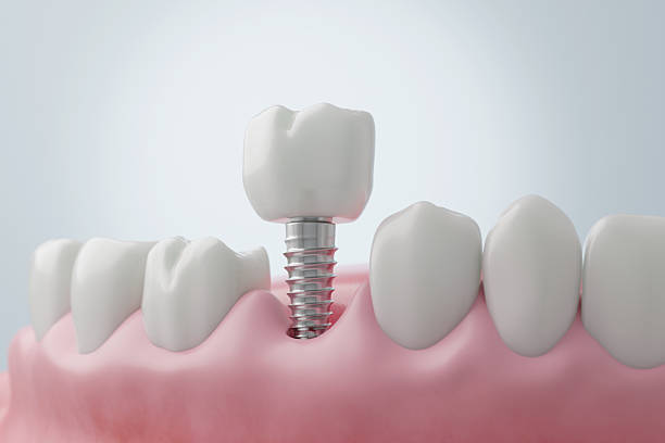 istock Titanium Dental Implant Surgery for Molar Tooth Replacement 2235378918