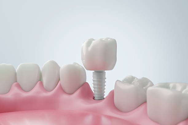 istock Zirconia Implant Placing Ceramic Dental Crown 2235379461