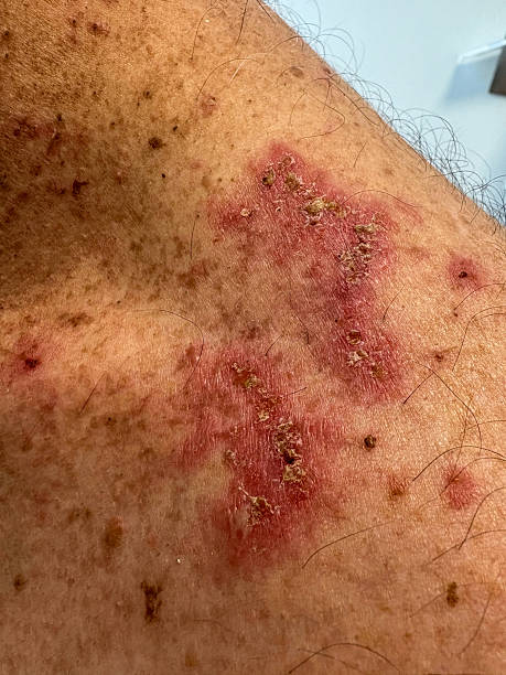 istock biopsy-confirmed pemphigus patient 2235814446