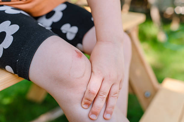 istock An abrasion and a patch mark on the child's knee outside. 2235860810