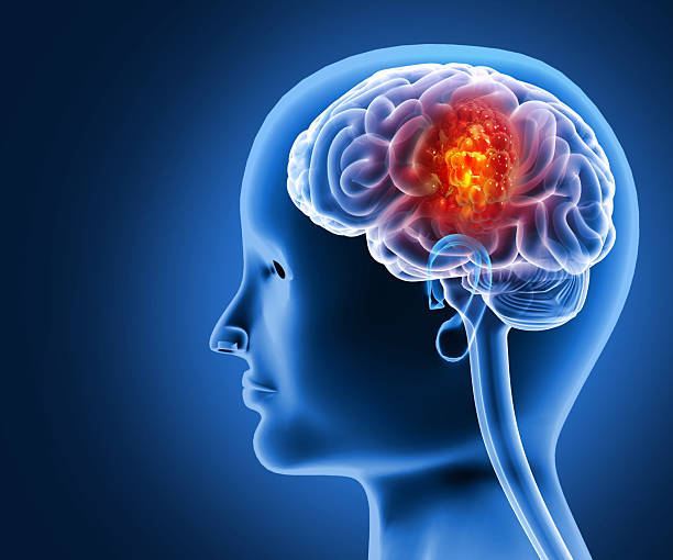 istock Brain tumor or barin cancer. 3d illustration 2236254858