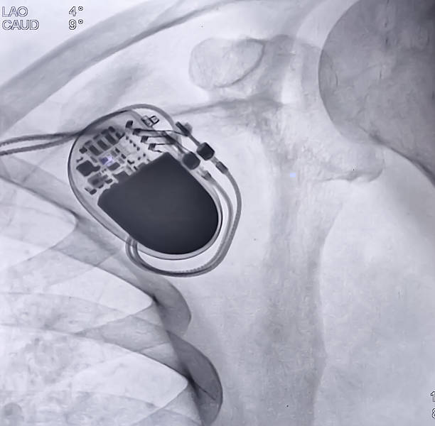 istock X ray image showed dual chamber permanent pacemaker (PPM) leads and generator in upper left chest under clavicle at Cath Laboratory. 2236286124