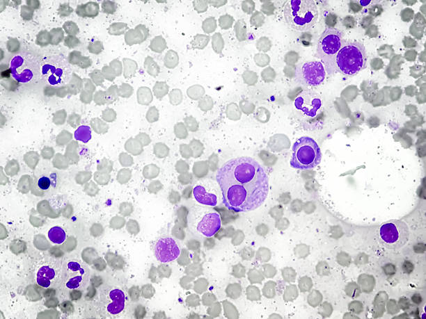 istock Bone marrow study: Plasma cell dyscrasia. Smoldering or early multiple myeloma (the patient has a history of plasmacytoma at the dorsal vertebral level -L2) 2236567754