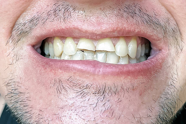 istock damaged and broken front teeth inside human mouth. Dental health problem, oral hygiene issue, close view of teeth defect 2236646380