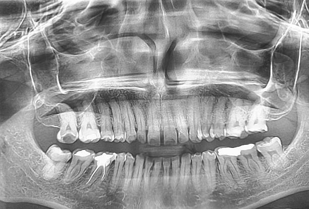 istock Panoramic dental X-ray showing teeth and jaw structure. Orthopantomography OPG x-ray. 2236687186