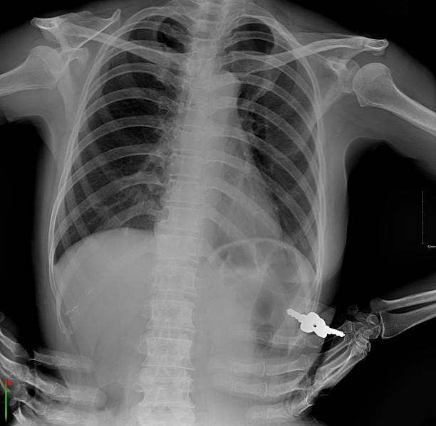istock This image is a chest X-ray showing a foreign body. 2236763370
