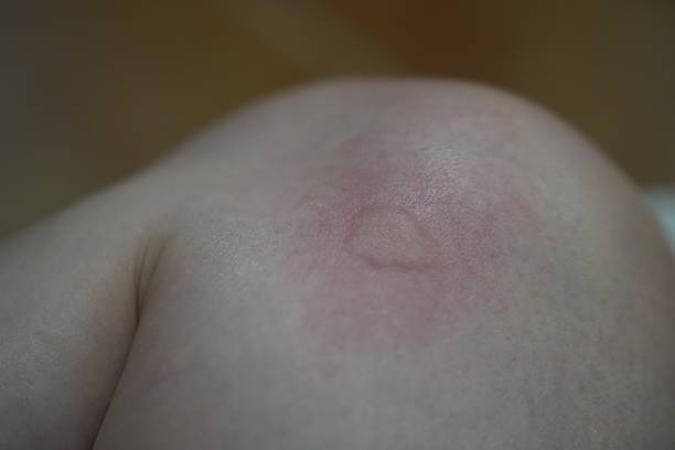 istock Close-up of a Large Mosquito Bite on a Human Thigh 2236896466