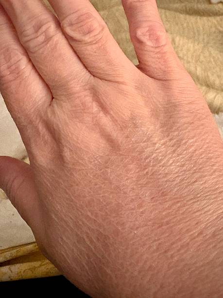 istock Autoimmune conditions causing dry scaly skin on a woman’s hands 2237020676