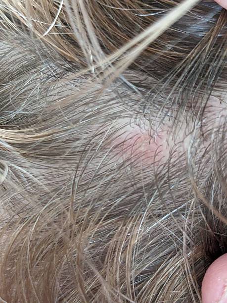 istock Hidradenitis suppurativa on a woman’s scalp 2237023389