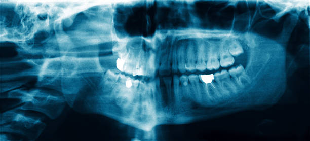 istock Panoramic dental X-ray radiograph image showing the entire mouth and jaw structure. Human skull with teeth, bone, and a filling for dentistry concept 2237410521