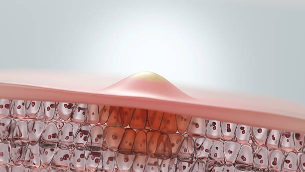 istock Cross Section of Acne Pustule with Deep Skin Inflammation, 3D Render 2237466470