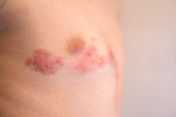 istock shingles (herpes zoster) on the skin 2237910902