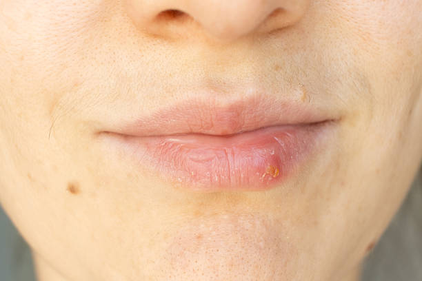istock Macro Closeup of Herpes on Human Lip. 2238119198