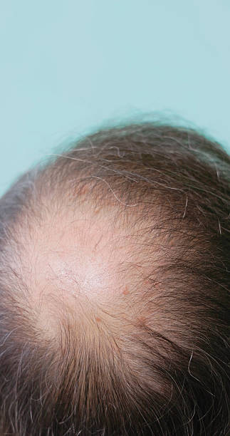 istock observe signs of baldness 2238251708