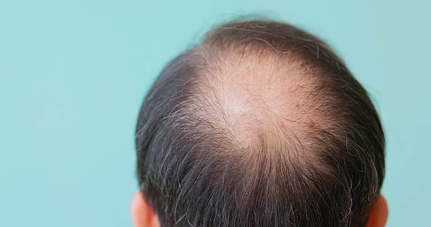 istock observe signs of baldness 2238251730