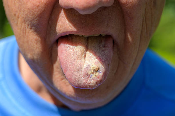 istock Elderly Man Tongue Lesion Closeup 2238676790