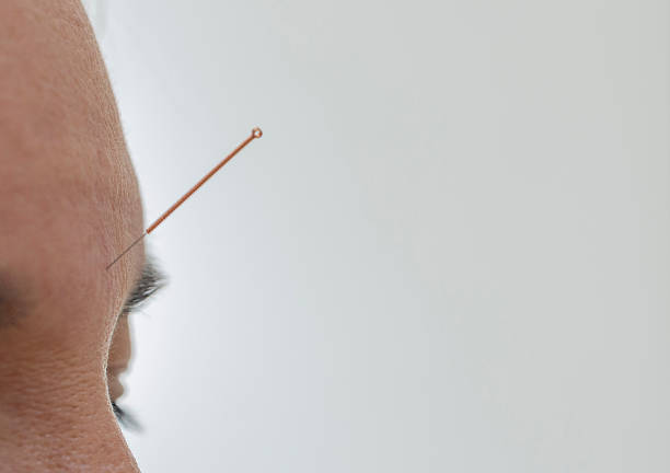 Person receiving an acupuncture treatment on the forehead, showcasing alternative medicine and traditional healing practices for wellness, health, and therapy