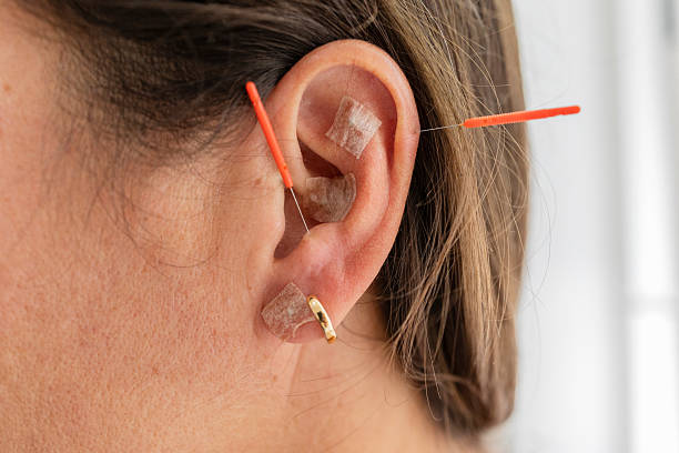 istock Woman getting auricular acupuncture treatment for wellness 2239116118
