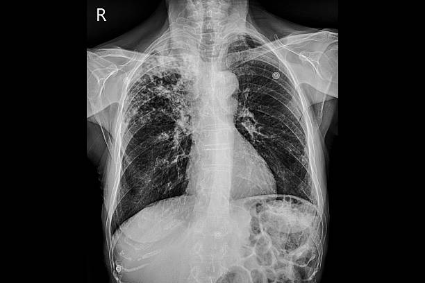 Medical themes: Chest X-ray image of patient with tuberculosis infection